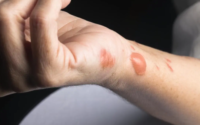 How to treat a grease burn
